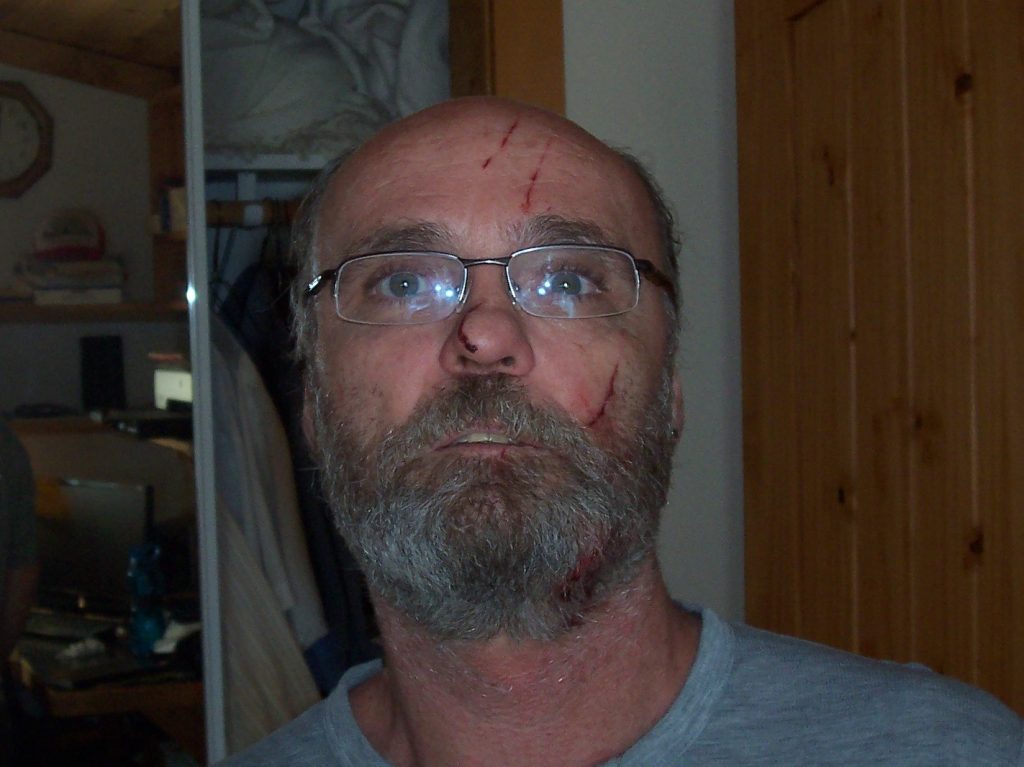 Close-up of the scrapes on Eric's face after his fall, hunter safety concept. 